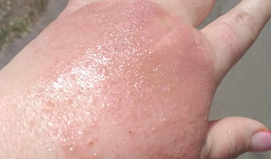 IMAGINI ŞOCANTE. O femeie din Brăila s-a ales cu arsuri grave pe mâini după ce a utilizat dezinfectant la un supermarket FOTO