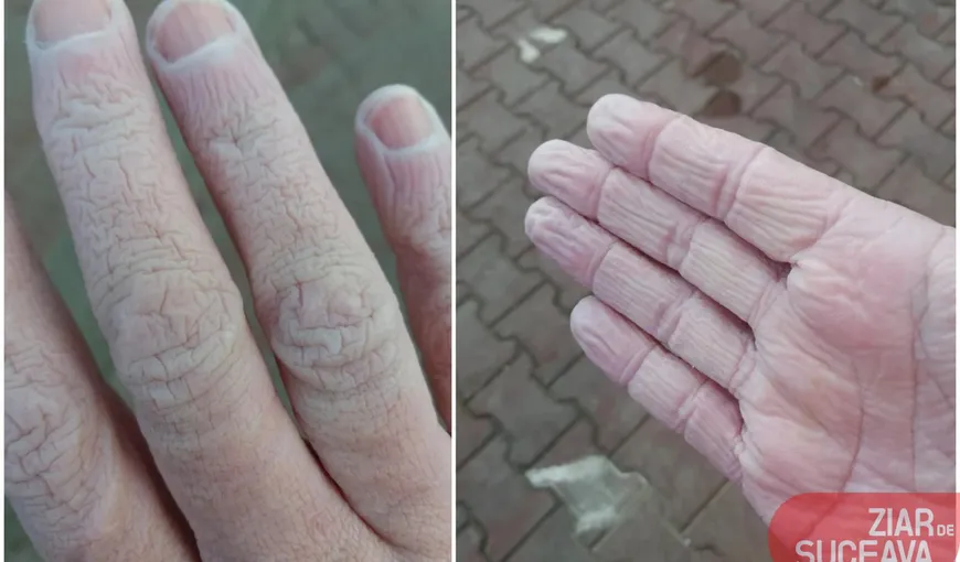 Impresionant! Cum arată mâinile unui cadru medical după 12 ore de muncă. Trebuie să poarte trei perechi de mănuşi una peste alta