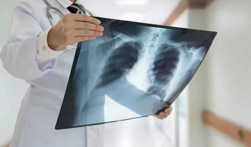 Mărturia unui medic rezident din Suceava: „Vedeam pur şi simplu cum plămânii bolnavilor se făceau bucăţi”