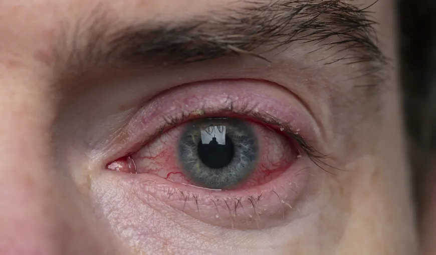 Ochii roşii pot fi un simptom al coronavirusului. În Canada, pacienţii cu conjunctivită sunt trataţi ca potenţiali purtători de Covid