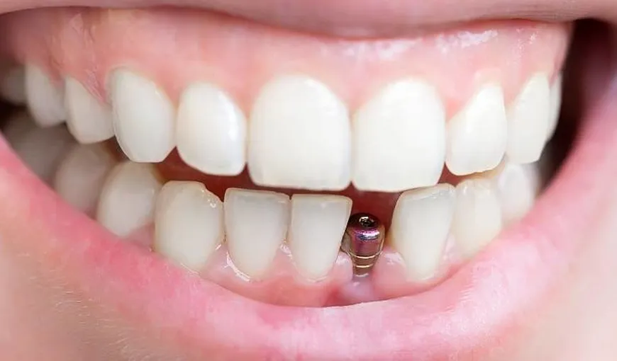 5 curiozităţi despre implanturile dentare