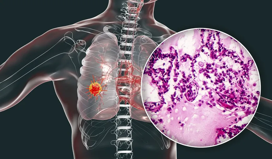 Testul care îţi arată dacă ai dezvoltat simptome de cancer la plămâni