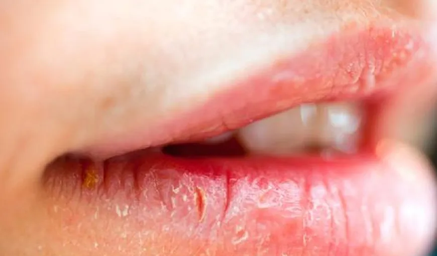 Ai buzele crăpate? Ţi-ar putea lipsi vitamina care scade riscul de cancer!