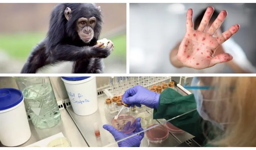 Variola maimuţei se răspândeşte rapid în Europa. Un medic român avertizează: „Se transmite şi prin haine. Mutațiile fac ca virusul să devină mai puternic”