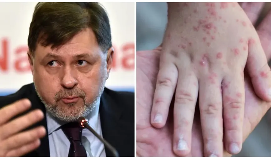 EXCLUSIV | Alexandru Rafila, avertisment despre infecţiile cu variola maimuţei. „România nu este pregătită. Nu există vaccinuri. Vaccinul variolic era produs în 1979”
