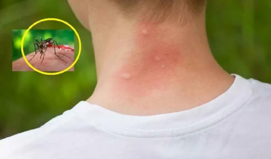 Cele mai simple metode ca să scapi de țânțari. Cât de periculoase sunt muşcăturile şi cum se tratează