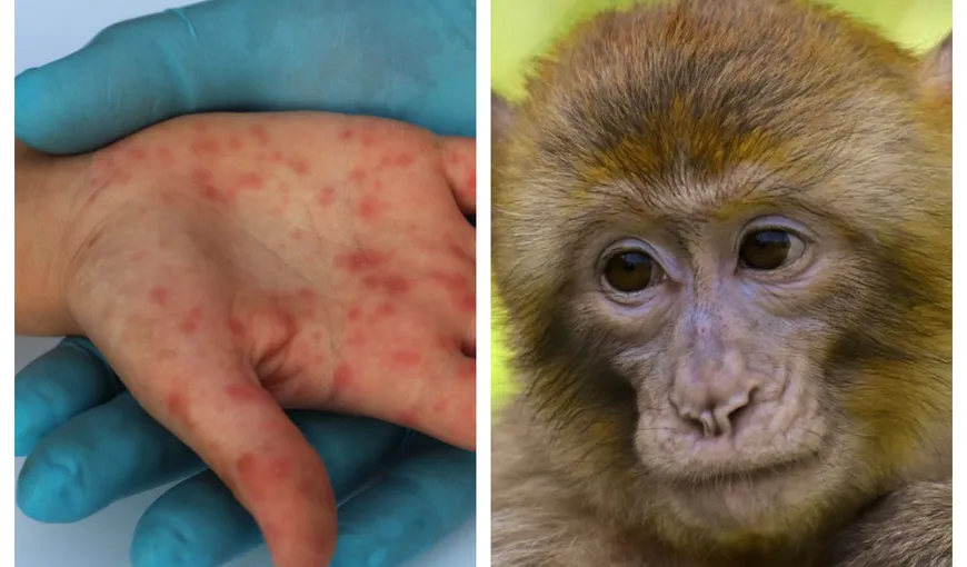 Variola maimuţei se extinde, sunt deja peste 200 de cazuri confirmate