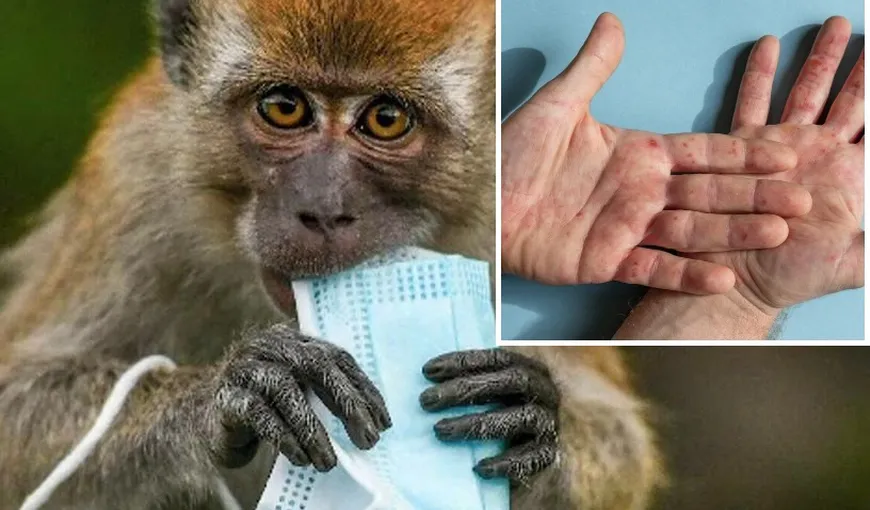 A revenit variola maimuței, „asasinul tăcut”. Cercetătorii au descoperit că virusul se transmite înainte de primele simptome