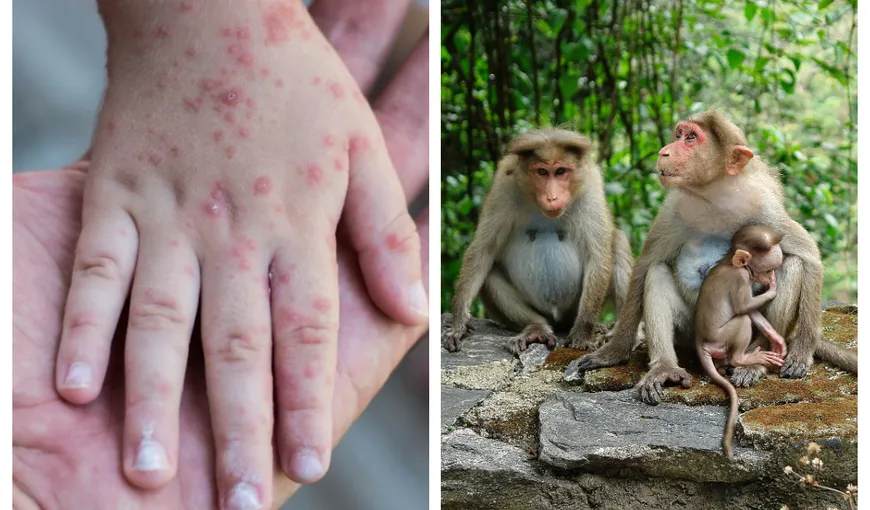 „Variola maimuţei”, boala care face ravagii în Anglia. Ce simptome au bolnavii infectaţi cu virusul care îi sperie pe epidemiologi
