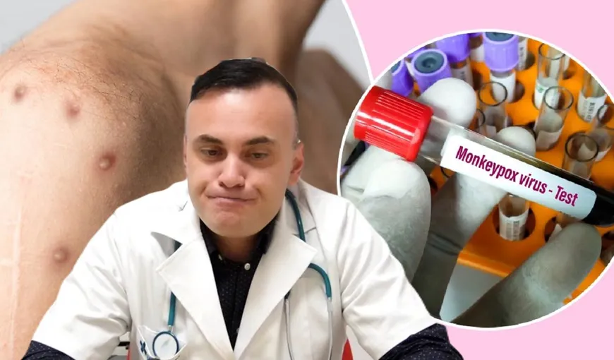 Adrian Marinescu: „Persoanele născute după 1979 au un risc mai mare de infectare cu variola maimuței”