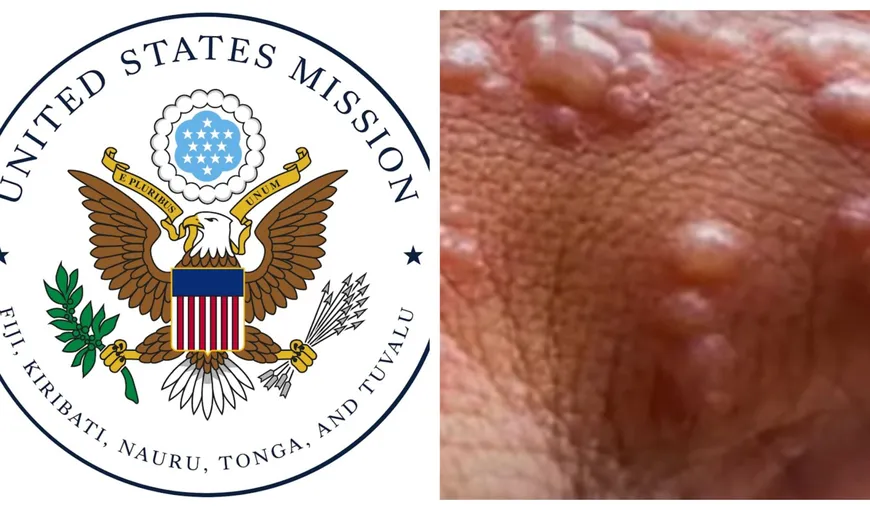 Ambasada SUA, alertă după creşterea numărului de infecţii cu variola maimuţei în România. Recomandări stricte pentru cei care vor să viziteze ţara noastră