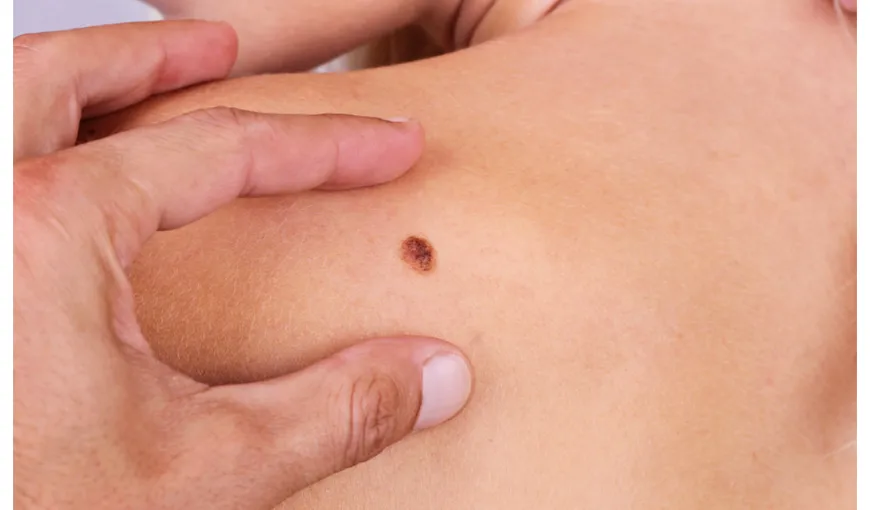 Medicii avertizează că verile căldurose vor duce la o explozie a cazurilor de cancer de piele