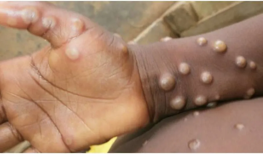 Primul deces cauzat de variola maimuţei a avut loc în India. Tânărul se întorsese recent din Emiratele Arabe Unite