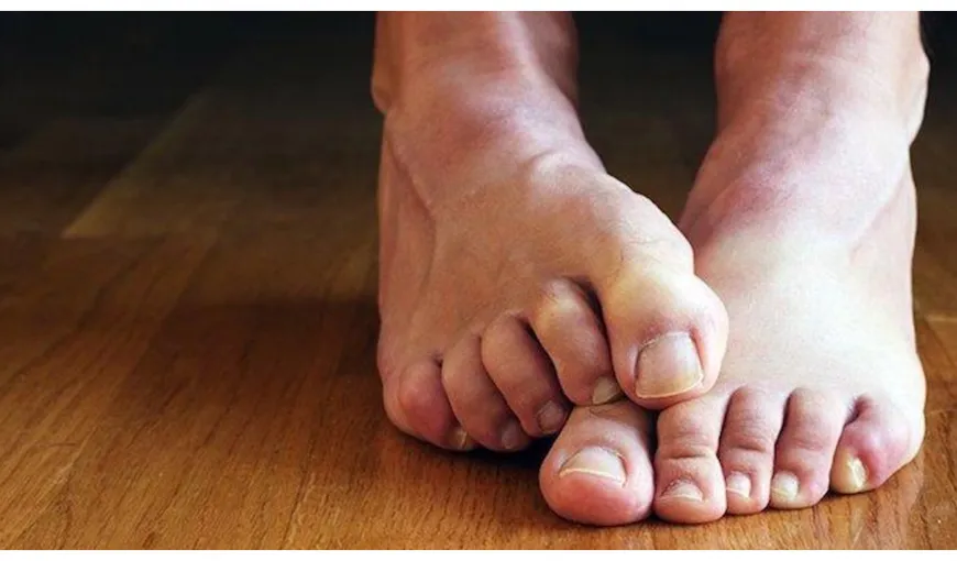 Ciuperca unghiei piciorului – cum apare și ce tratamente există?